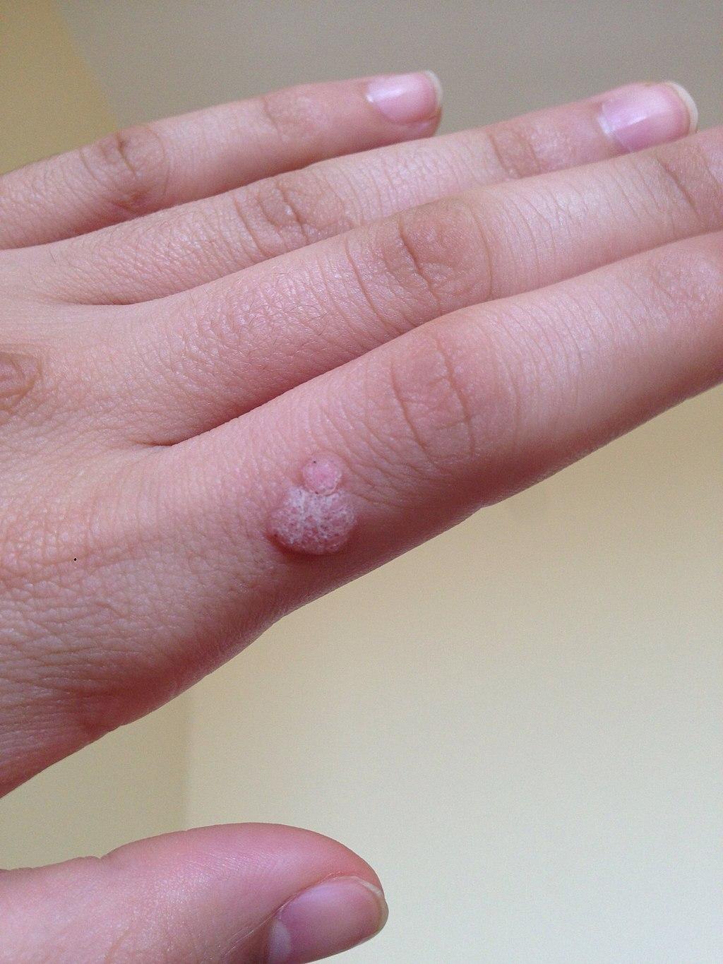 Hand wart