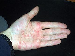 Pompholyx hand