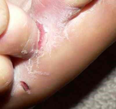 Tinea pedis