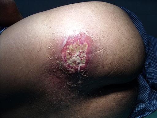 pictures of boils on private area