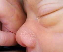 Milia newborn