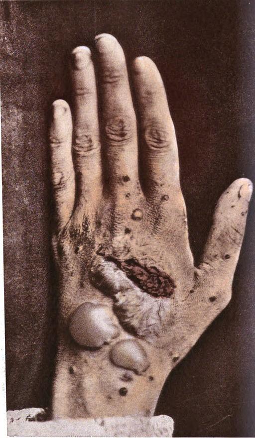 Pemphigus foliaceus