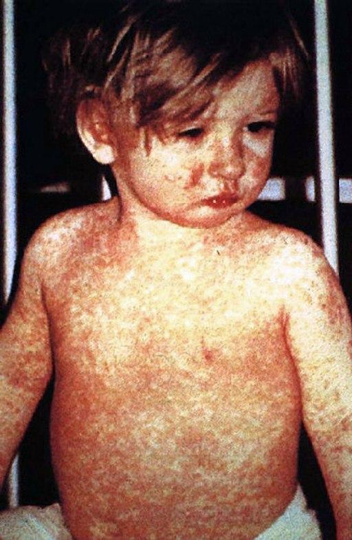 viral exanthem