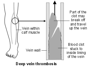 Diagram of leg showing veins and a Deep Vein Thrombosis