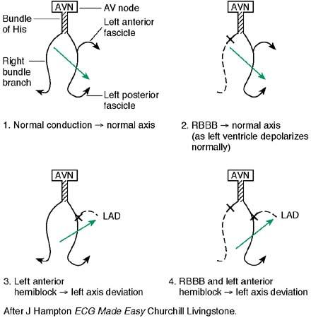 ECG AXIS AND CONDUCTION DEFECTS