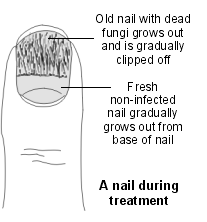 Diagram of a nail during treatment for fungal nail infection