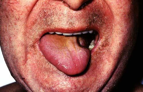 XII NERVE PALSY