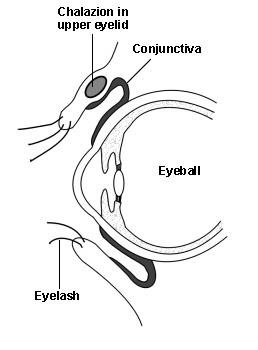 chalazion in the upper eyelid