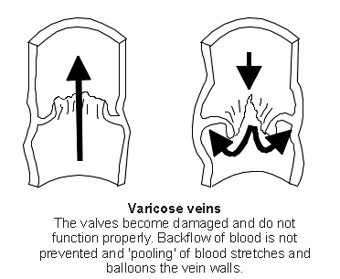 Varicose vein