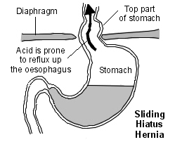 Sliding Hiatus Hernia