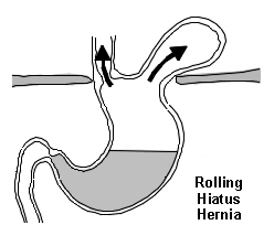 Rolling hiatus hernia