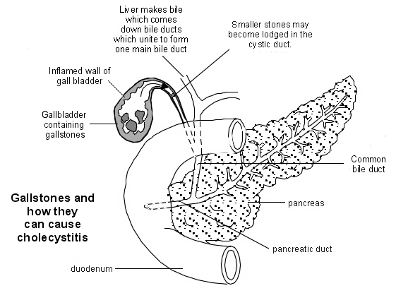 Gallstones causing cholecystitis