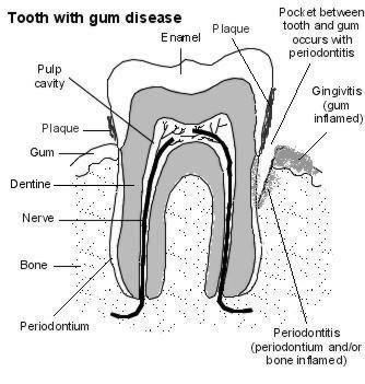 tooth with gum disease