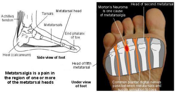 metatarsalgia