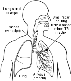 Lungs and airways with TB scar