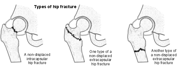 hip fracture