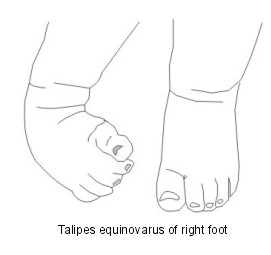 Club Foot (Congenital Talipes Equinovarus)