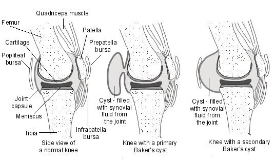 Baker's cyst