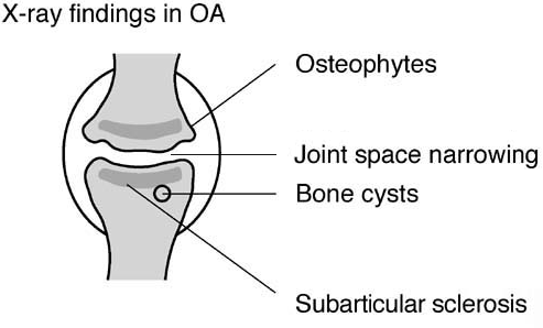 Osteoarthritis X-ray