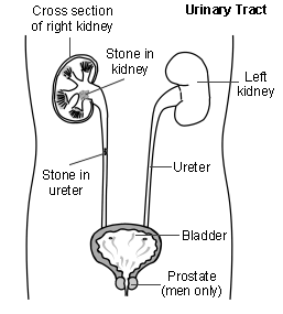 Kidney stones