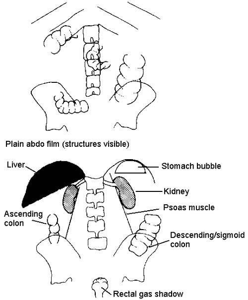 ABDOMINAL X-RAY