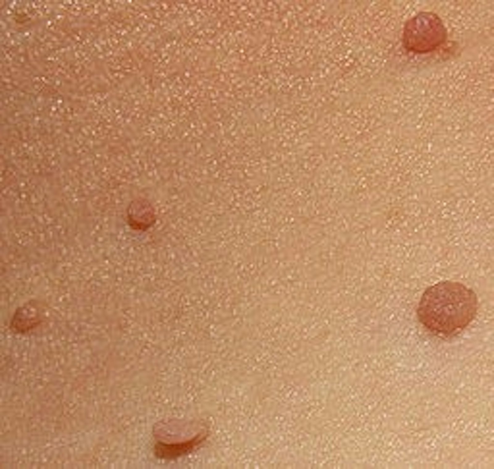 Skin tags