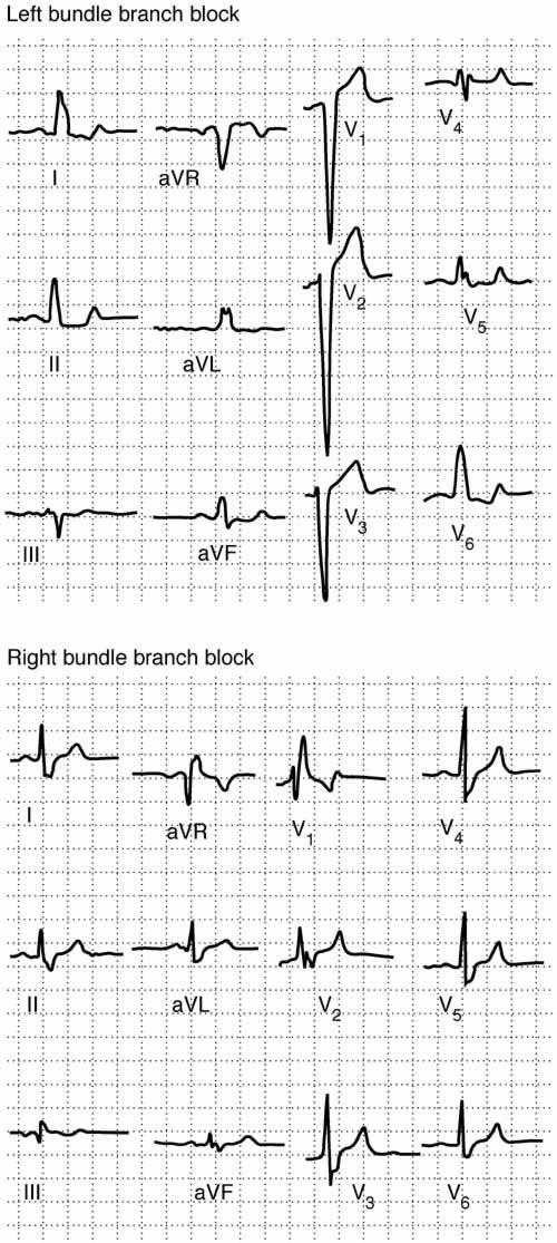 RIGHT AND LEFT BUNDLE BRANCH BLOCK