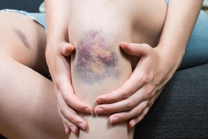 Ehlers-Danlos syndrome