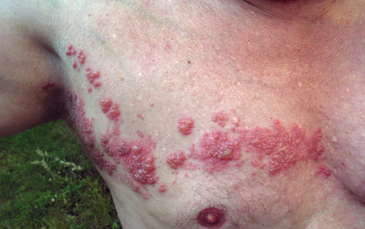 Photo of chest with shingles