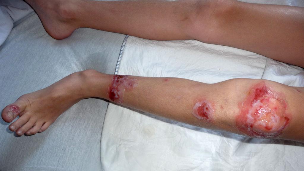 Bullous impetigo