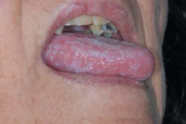 oral lichen planus