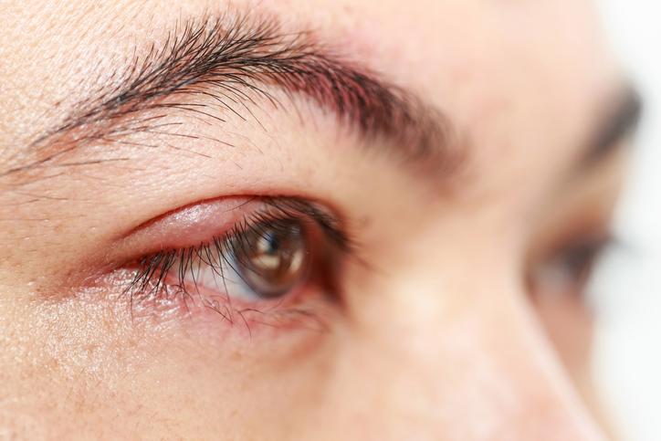 Chalazion