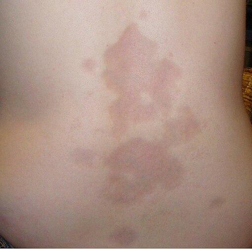 Scleroderma