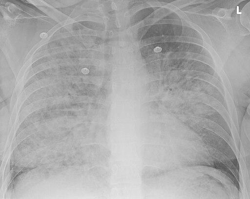 Aspiration pneumonia