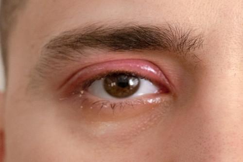 A close up of an eye with blepharitis