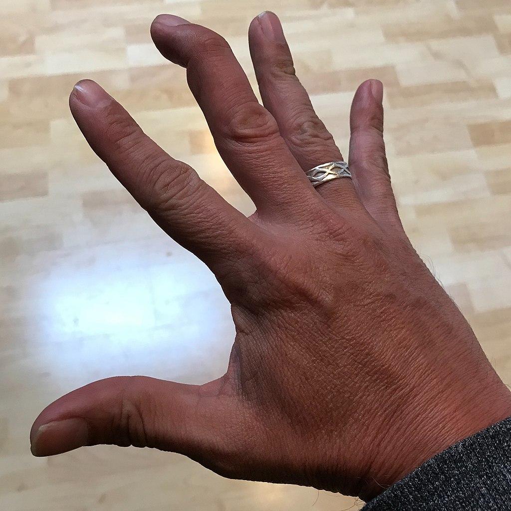 Photo of mallet finger