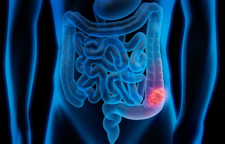 Bowel cancer