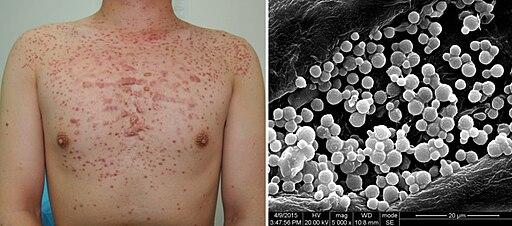 Photo of Folliculitis
