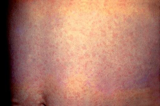 Photo of rubella rash