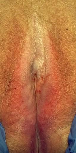 Lichen sclerosus