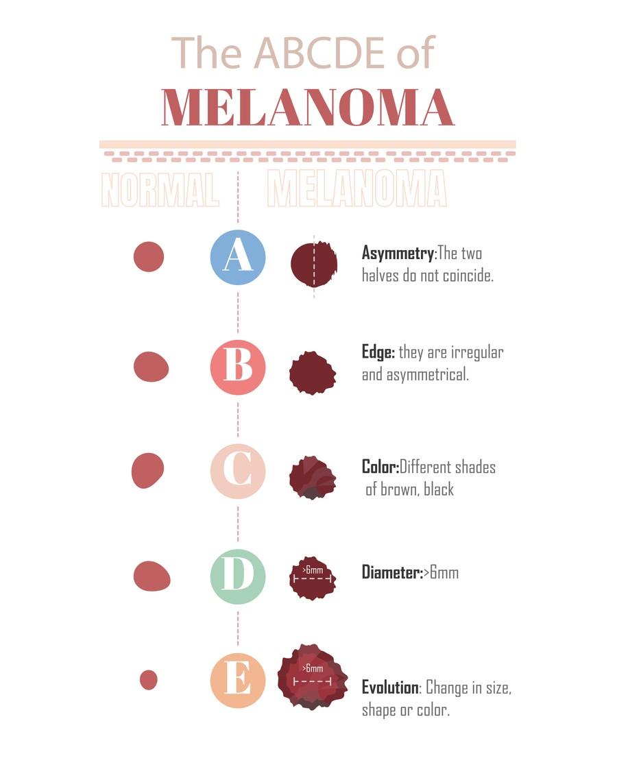 skin moles to worry about