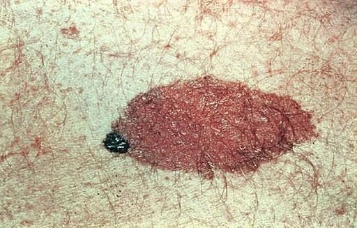 Congenital naevus