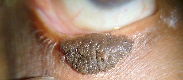 Epidermal naevus