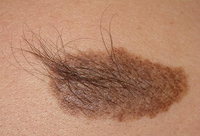 Becker's naevus on shoulder