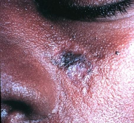Discoid_lupus_erythematosus