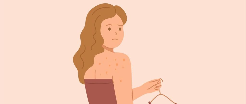 what causes back acne