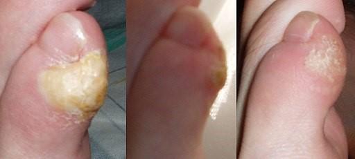 Callus