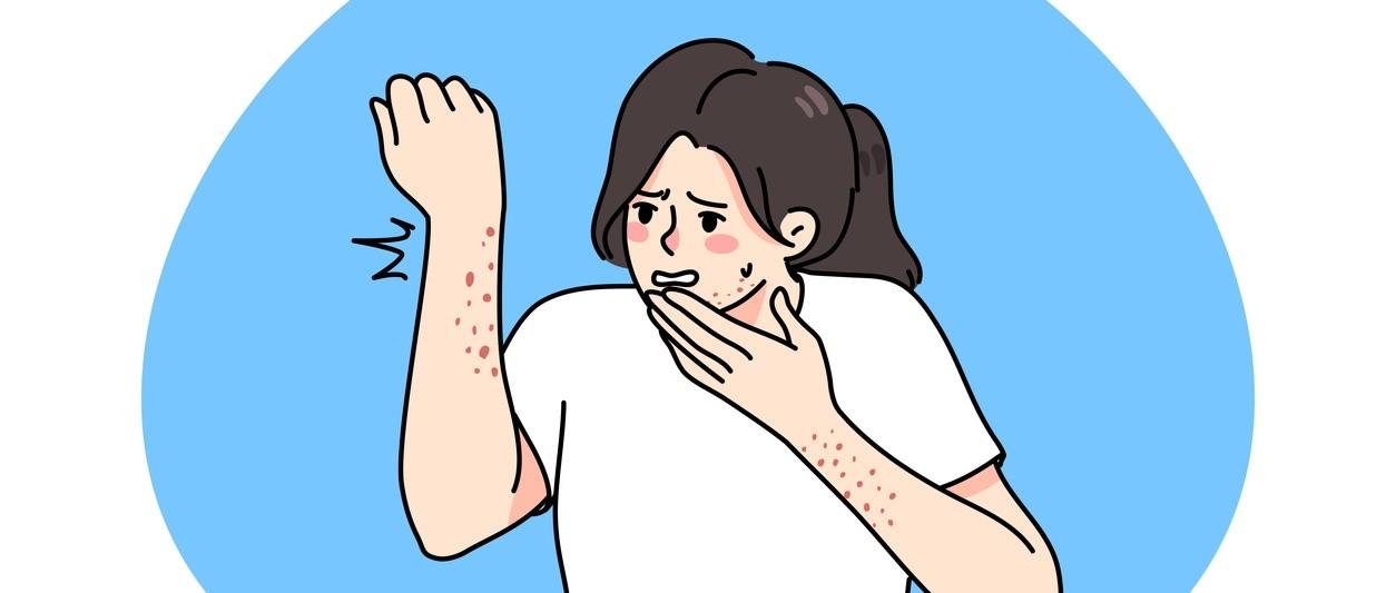 scabies