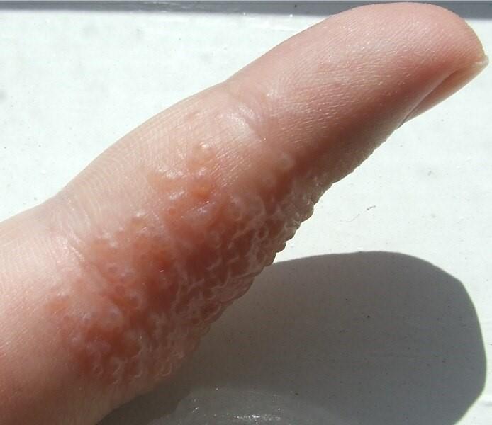 Finger_Pompholyx