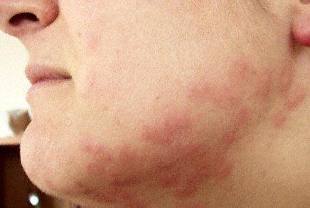 Bedbug Bites
